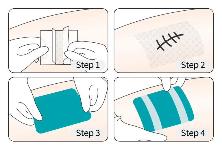 How to use Silicone Wound Contact Layer