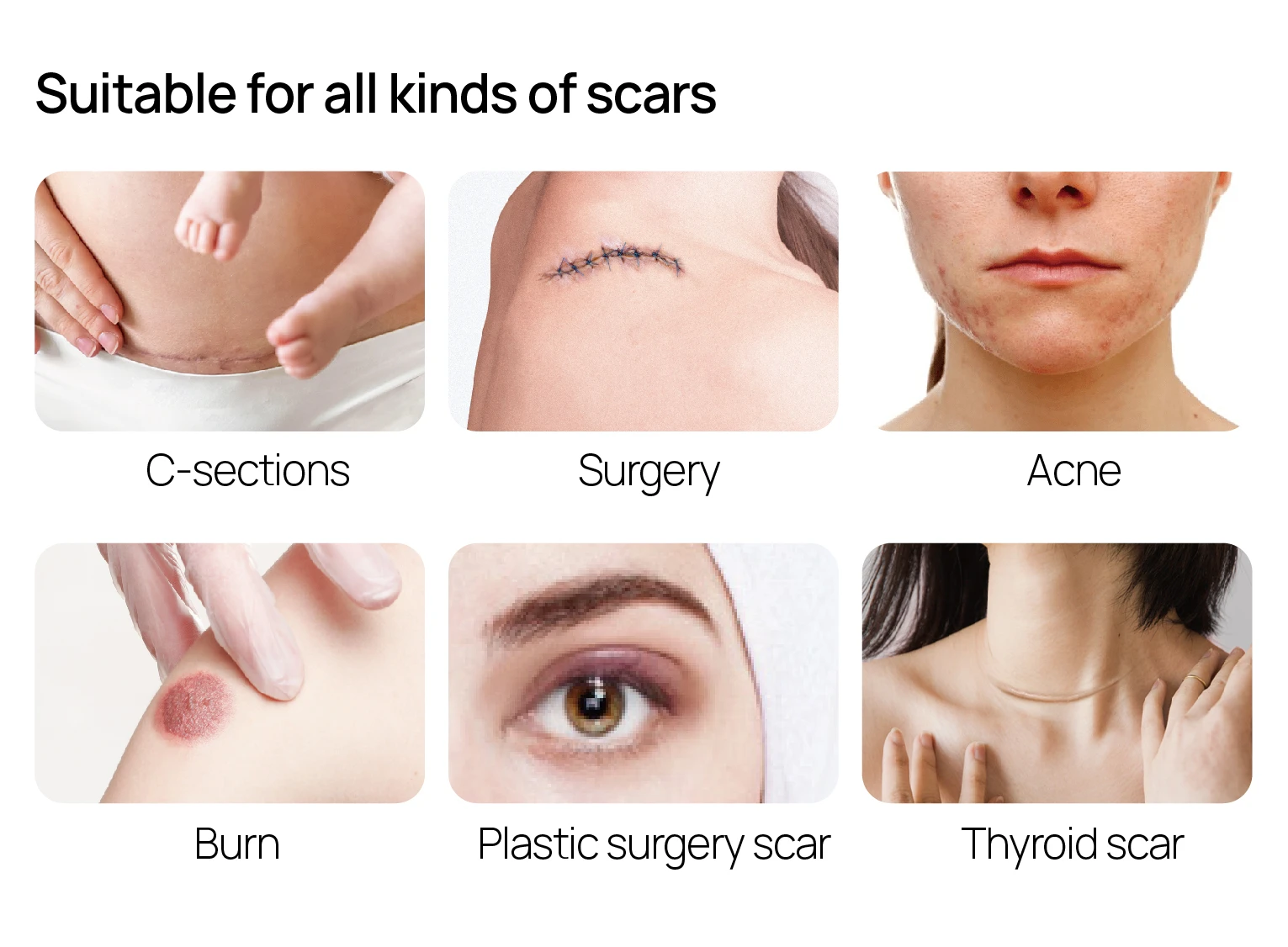 Silicone scar sheets are suitable for all kinds of scars