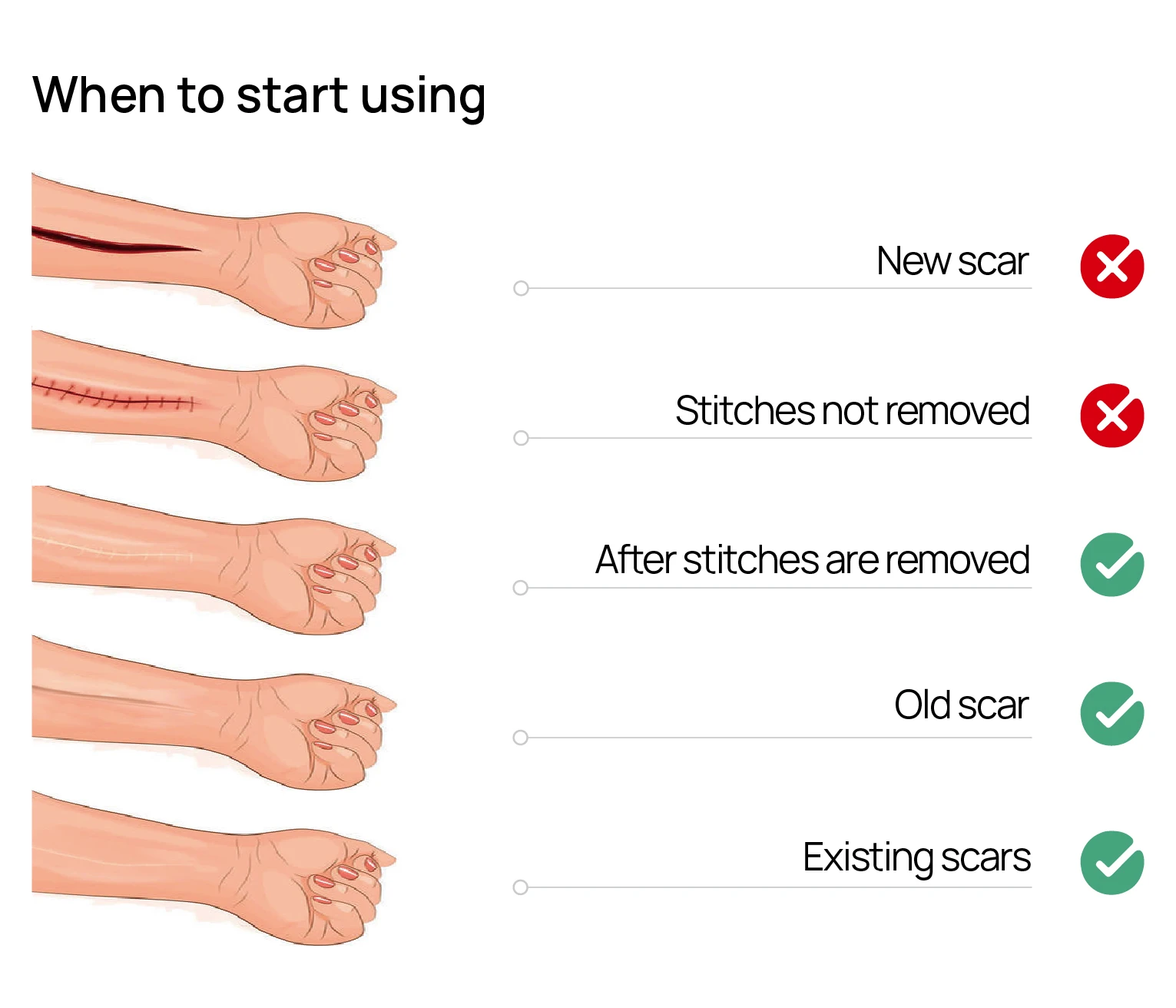 When to use silicone scar sheets