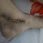The using scar sheet stage 1, the early post-operative stage