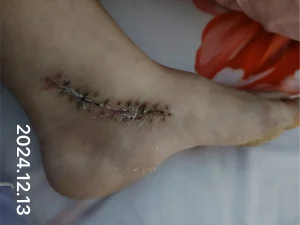 The using scar sheet stage 1, the early post-operative stage