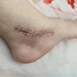 The using scar sheet stage 3