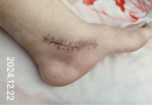The using scar sheet stage 3