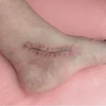 The using scar sheet stage 4