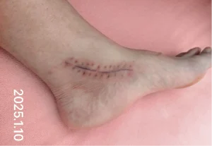 The using scar sheet stage 4