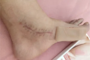 The using scar sheet stage 5