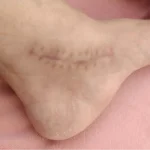 The using scar sheet stage 6