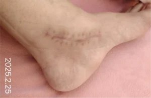 The using scar sheet stage 6