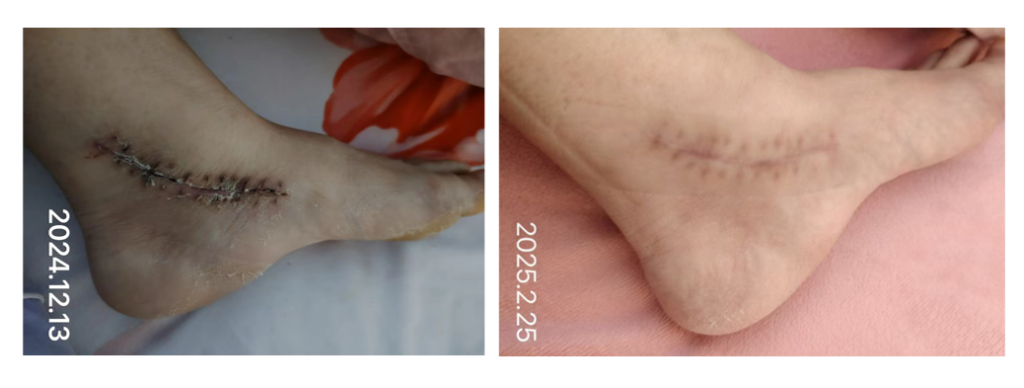 SLK Medical silicone scar sheet use comparison