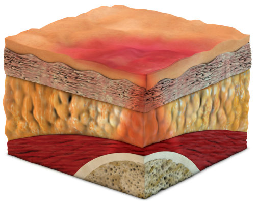 Pressure Ulcer Stage 1