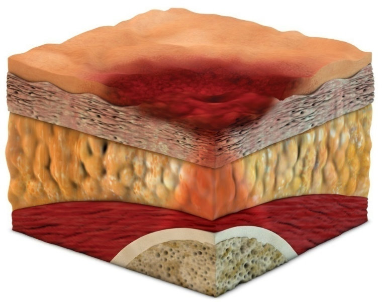Pressure Ulcer Stage 2