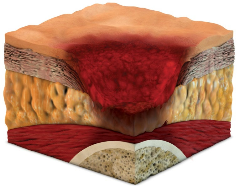 Pressure Ulcer Stage 3