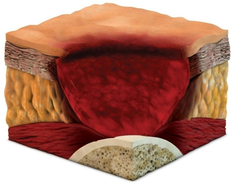 Pressure Ulcer Stage 4