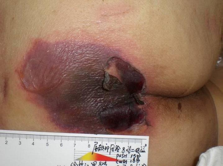 Suspected Deep Tissue Injury Stage
