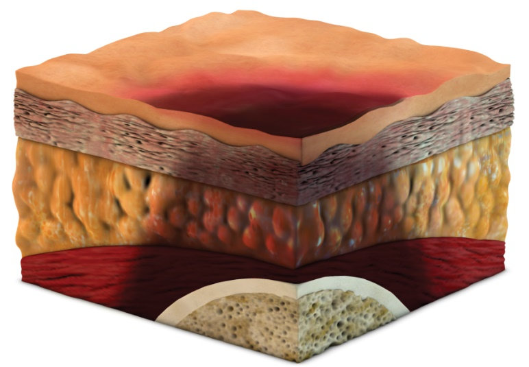 Suspected Deep Tissue Injury