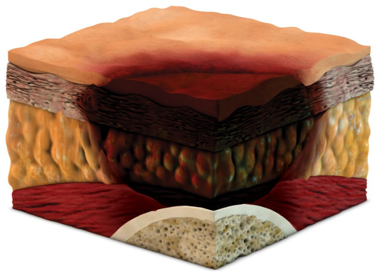Unstageable Pressure Ulcer