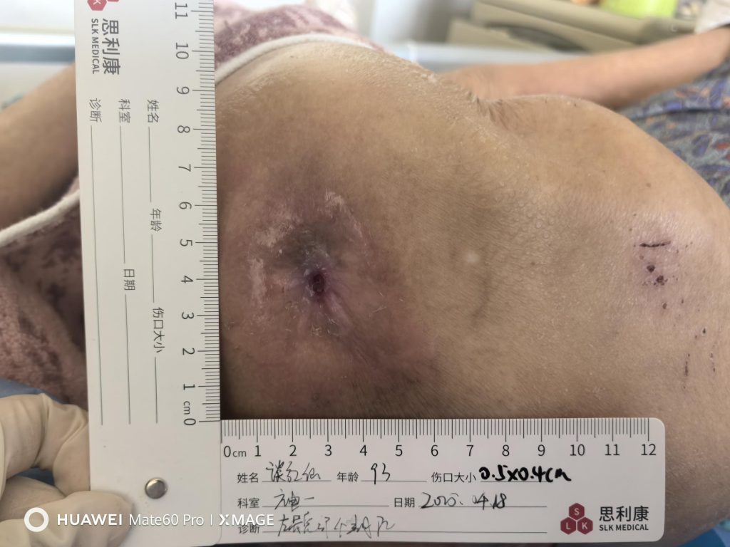 4.18 wound condition