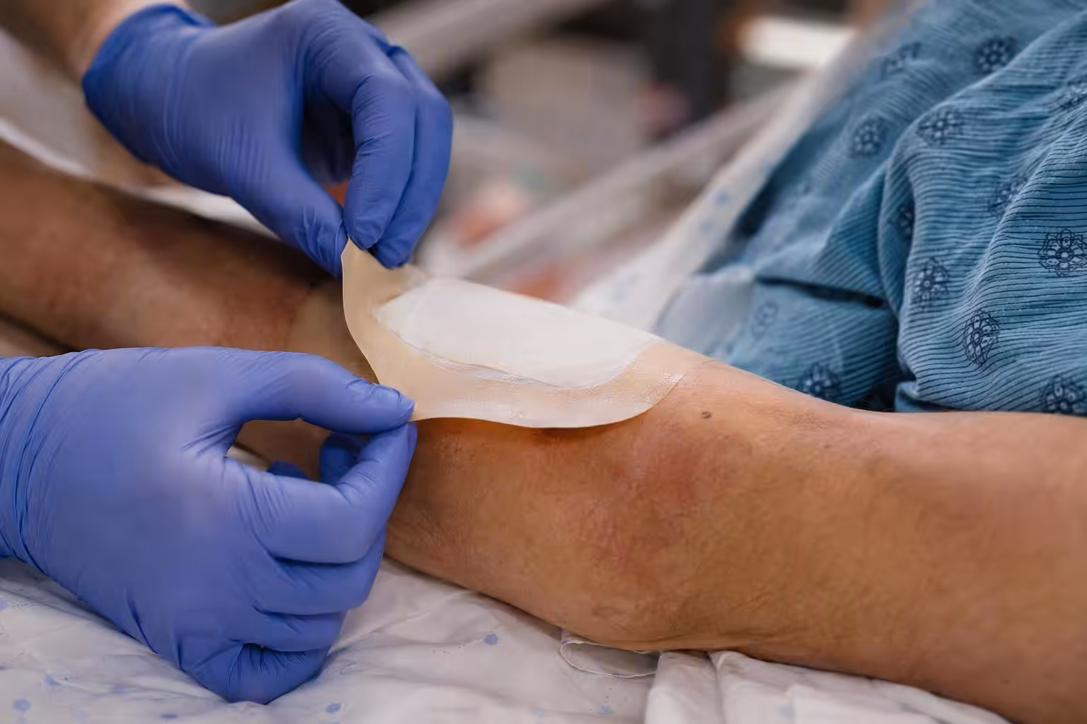 Step-by-step low-trauma removal of silicone-bordered foam