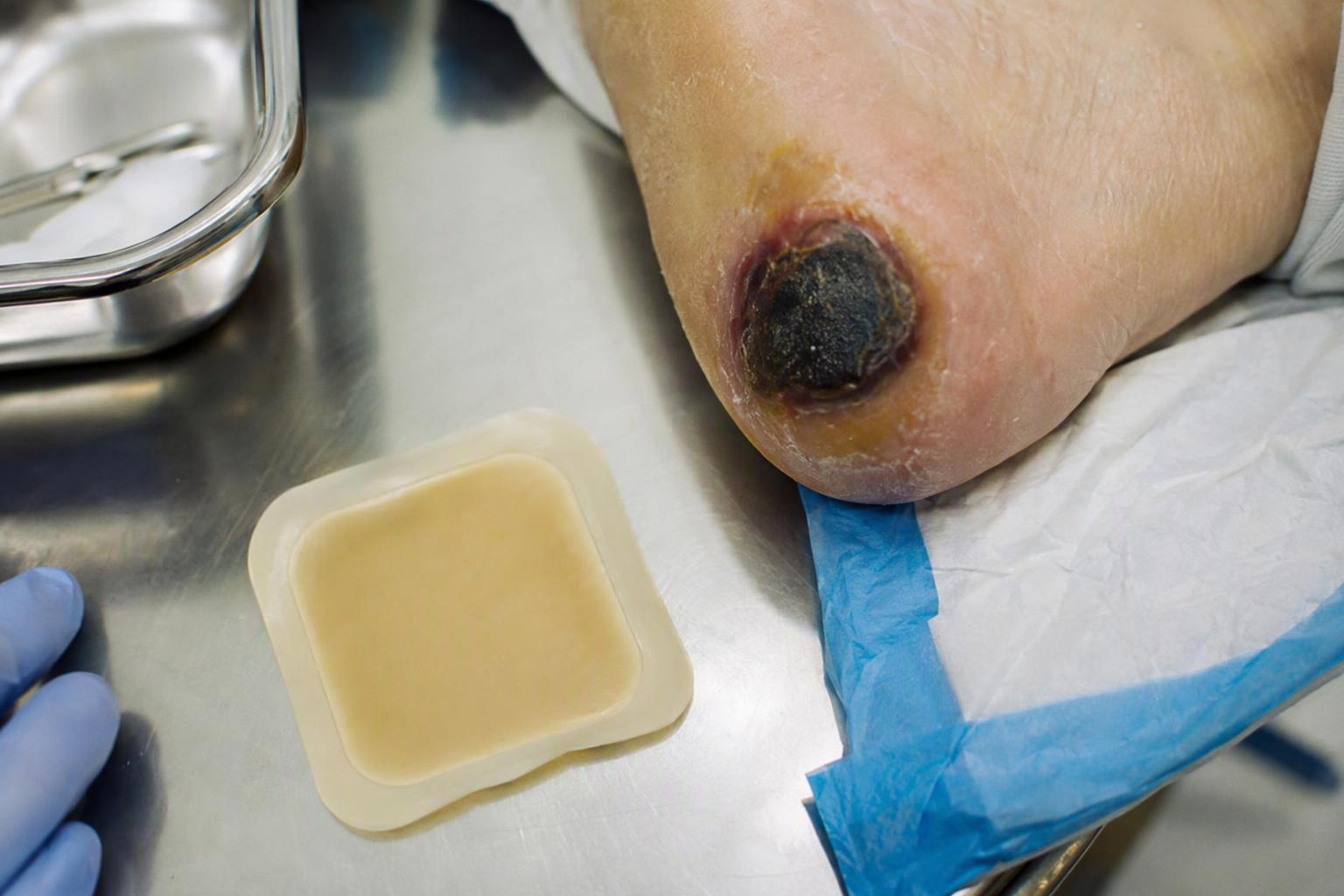 Wound care clinician comparing silicone foam and alginate dressings beside a pressure injury staging chart
