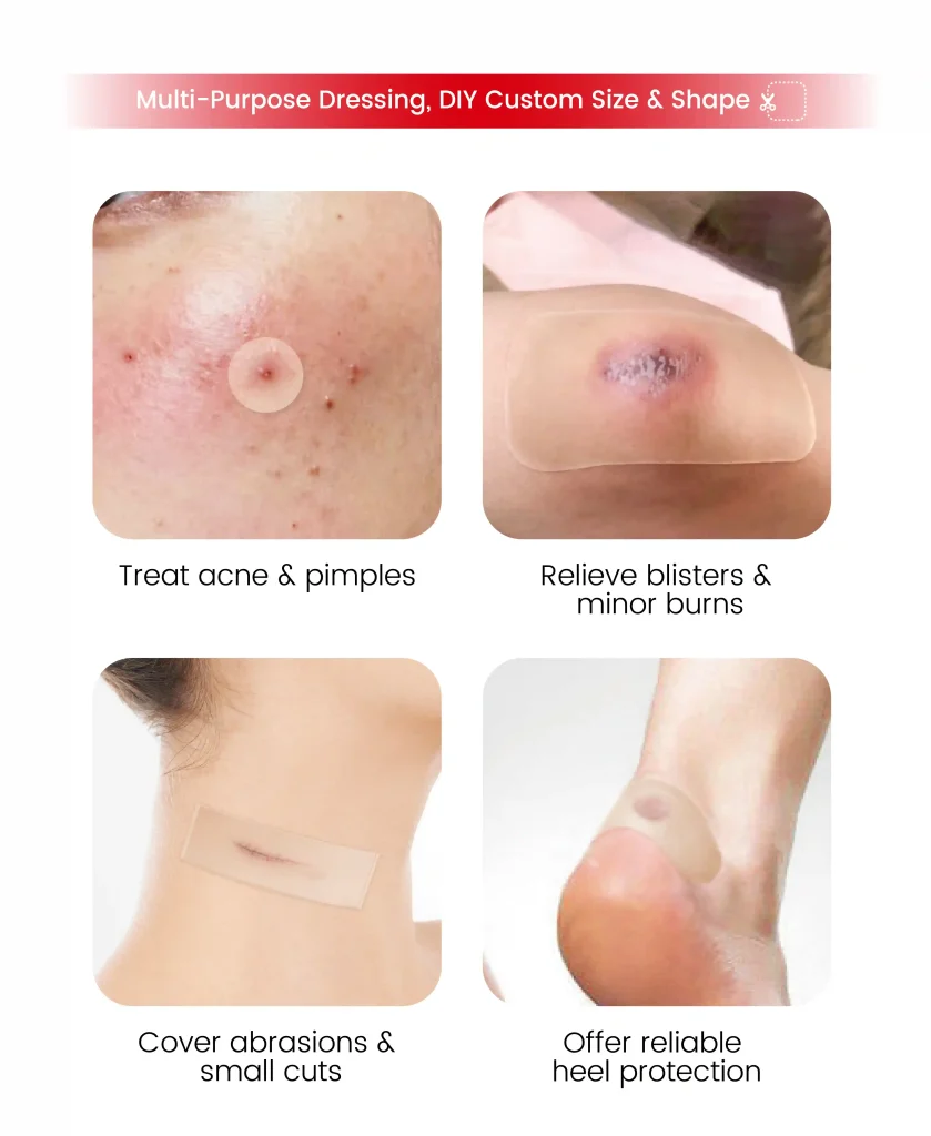 Application of hydrocolloid roll